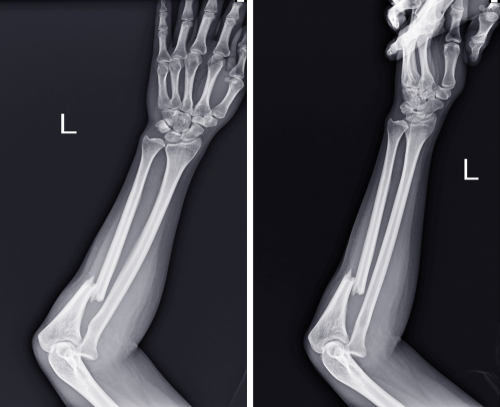 Fratura no antebraço
