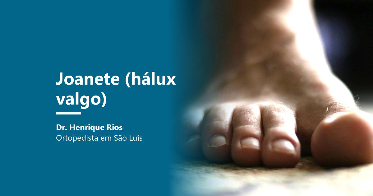 Joanete (hálux valgo): pé descalço