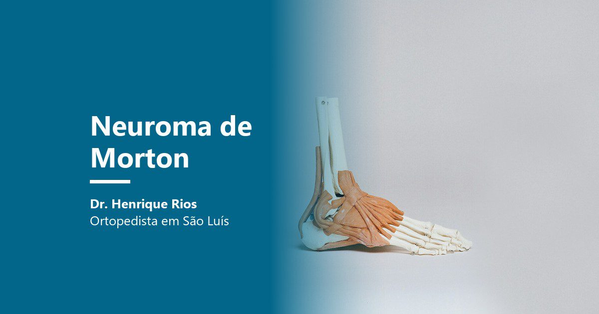 Neuroma de Morton: modelo anatômico do pé