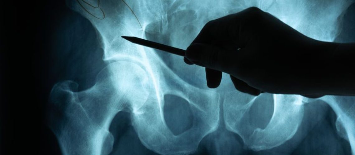 exame de biomecânica do quadril