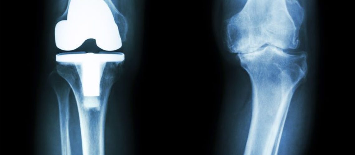 Prótese de joelho
