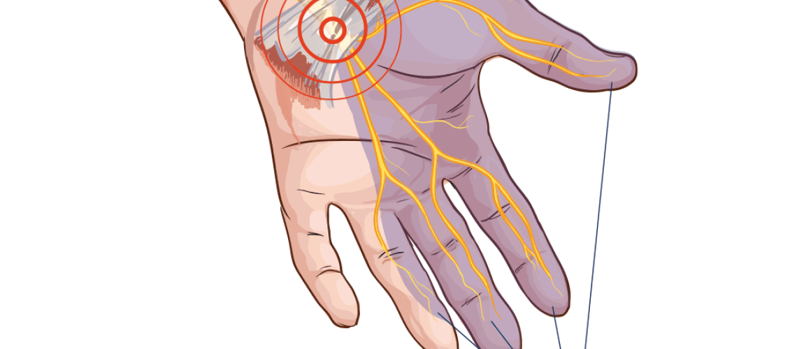 Sindrome-do-tunel-do-carpo-2