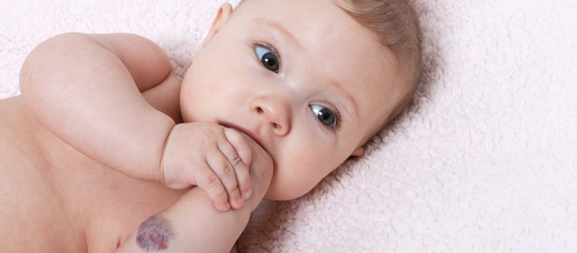 Hemangioma de Coluna Lombar