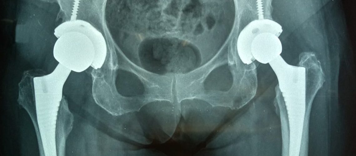 fraturas acetabulares