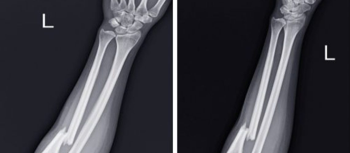 Fratura no antebraço