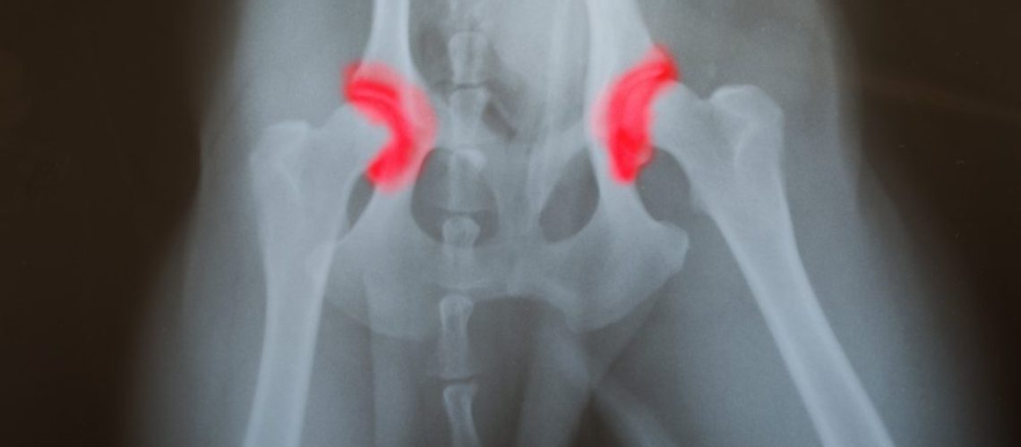 displasia no quadril