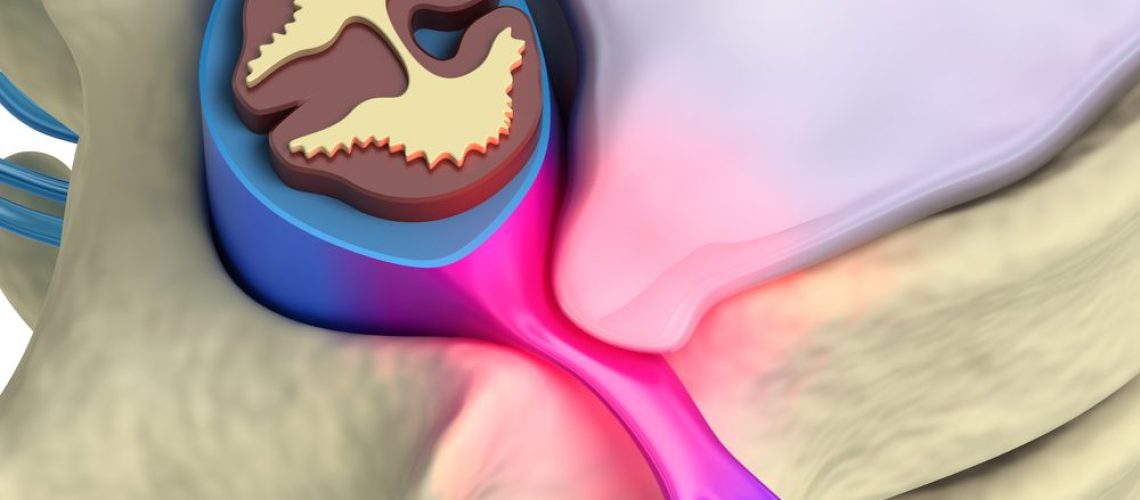 cirurgia de hérnia de disco